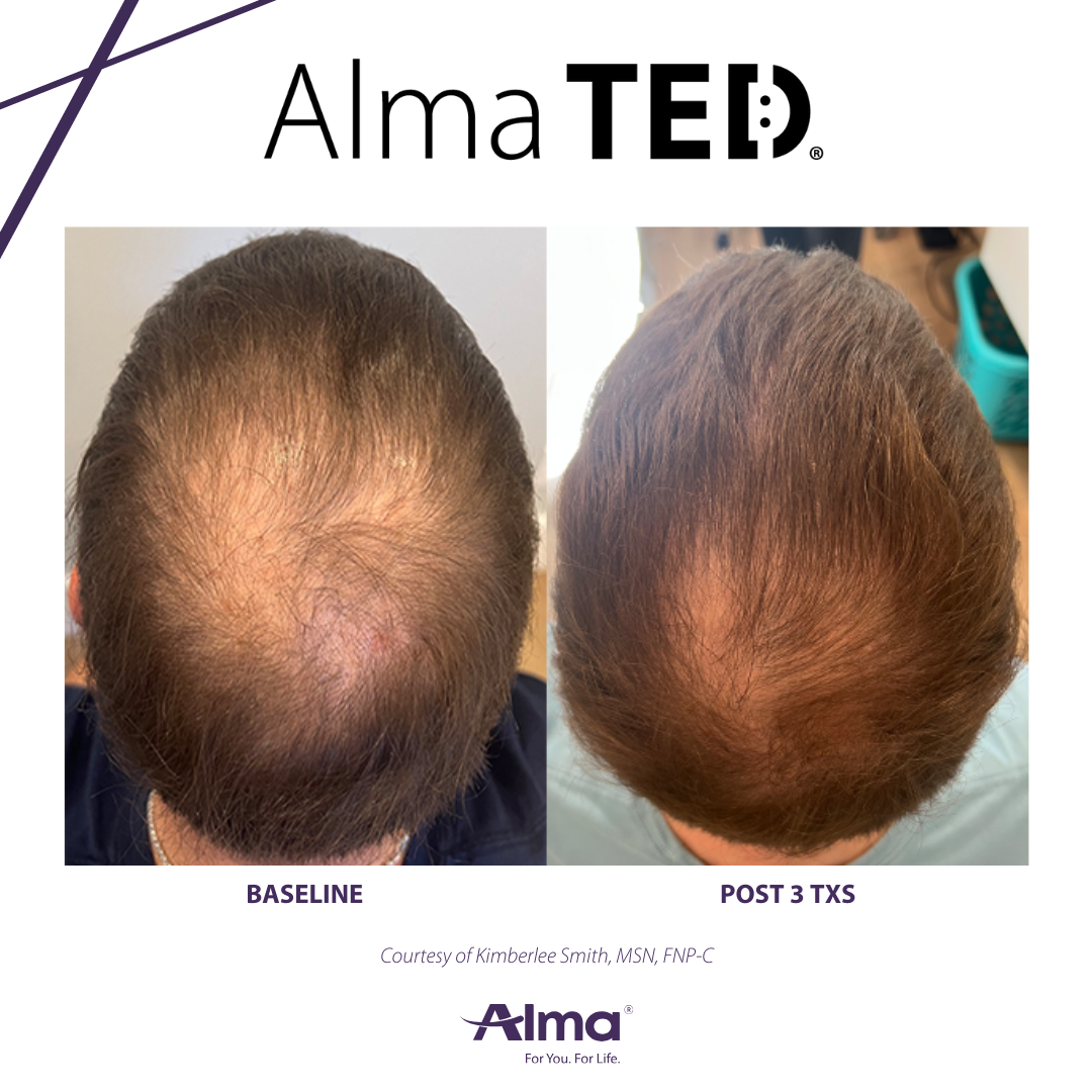 Do Alma TED Treatments help regrow hair?