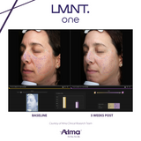 LMNT. Facial Device